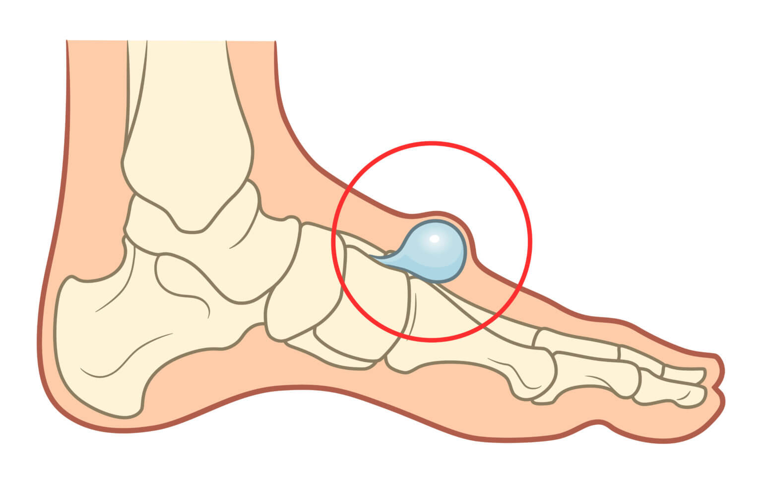 Lump On Foot Top After Injury