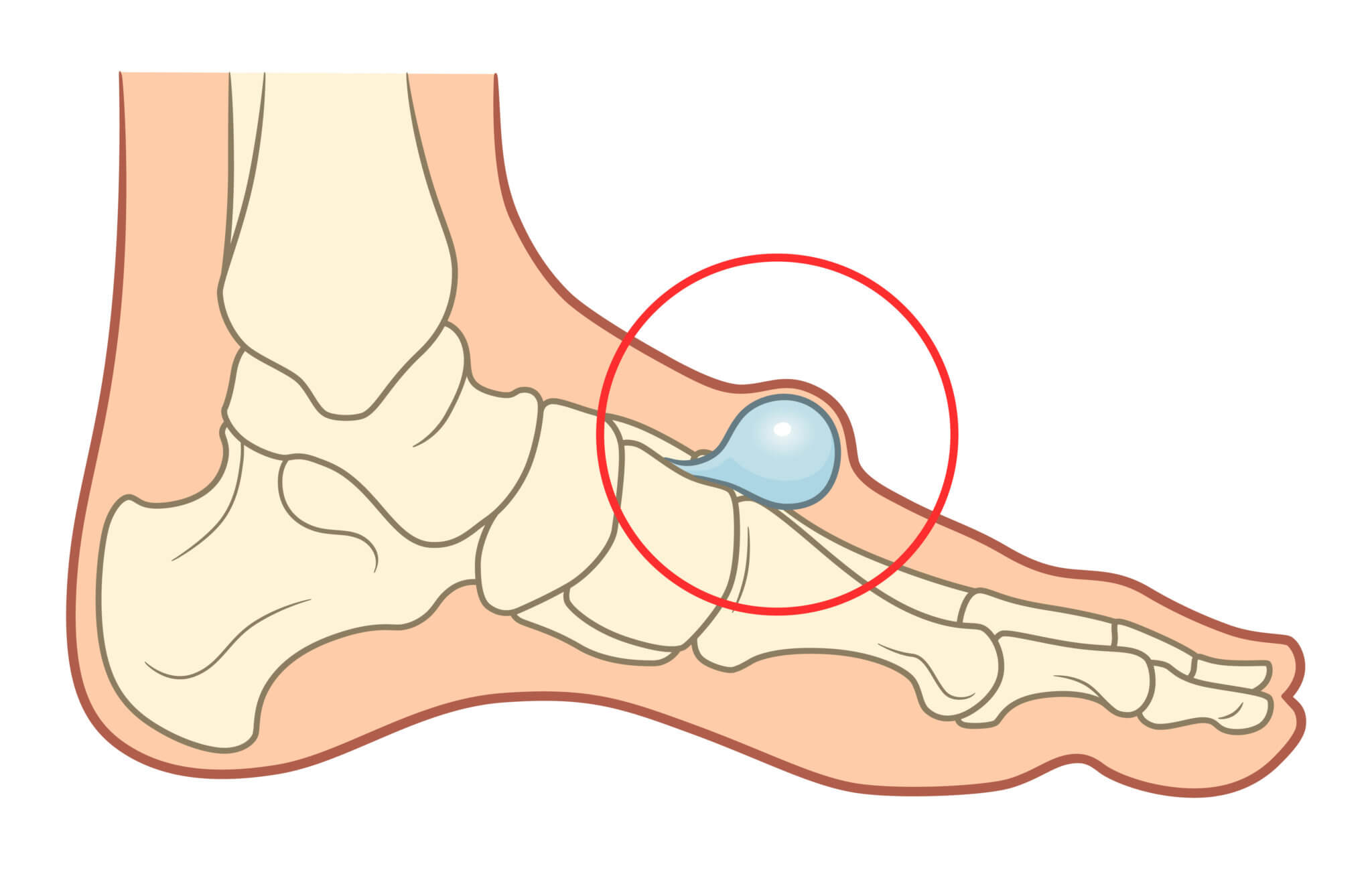 Ganglion So Verschwindet Es Lebensfreude Aktuell